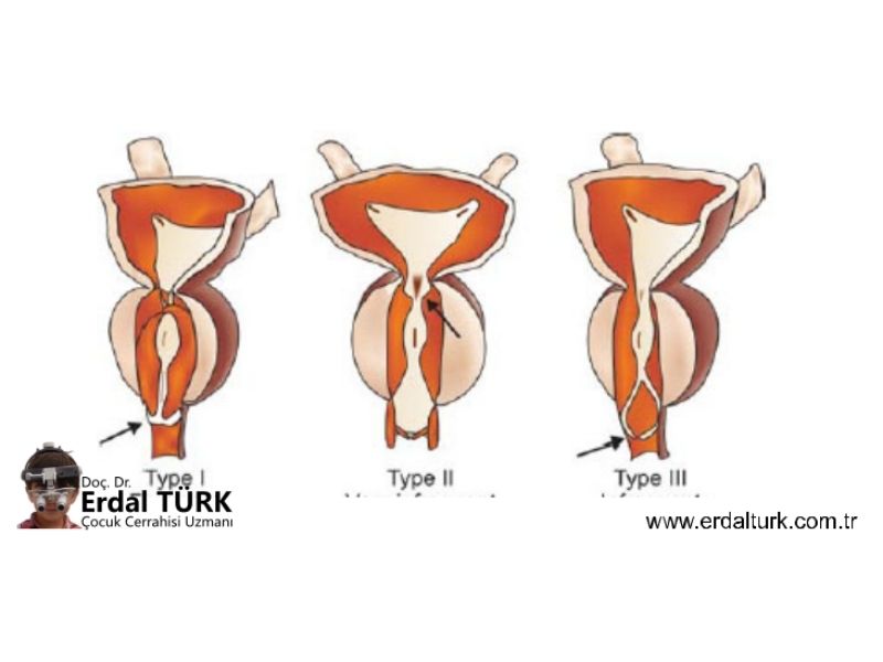 posterior-uretral-valv-resim-01