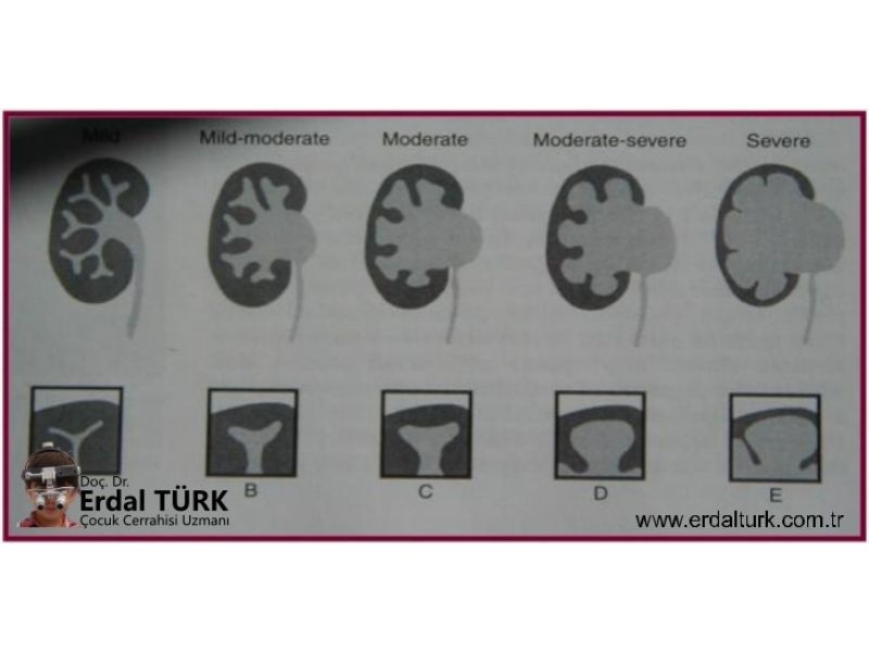 antenatal-hidronefoz-resim-01-b