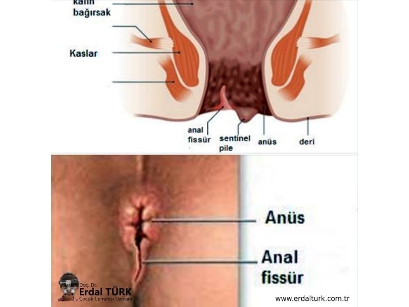 bebeklerde-ve-cocuklarda-anal-fissur-resim-01