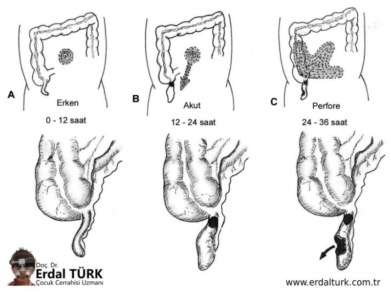 cocuklarda-apandisit-resim-02