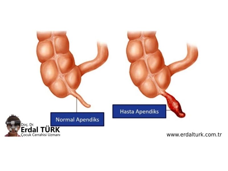 cocuklarda-apandisit-resim-01