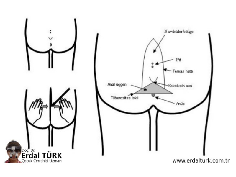 cocuklarda-pilonidal-sinus-hastaligi-01