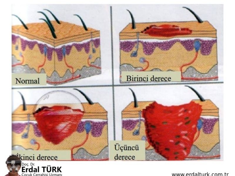 cocuklarda-yanik-ve-tedavisi-01