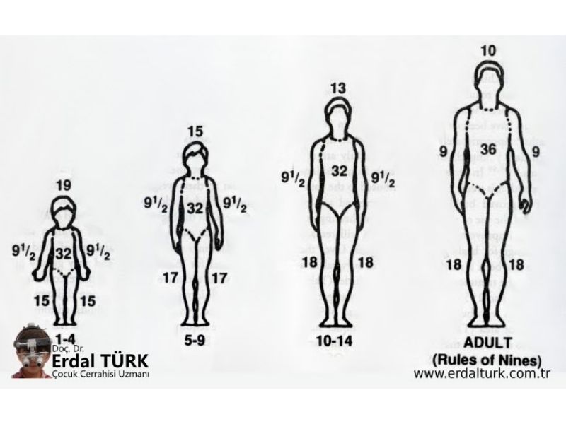 cocuklarda-yanik-ve-tedavisi-03