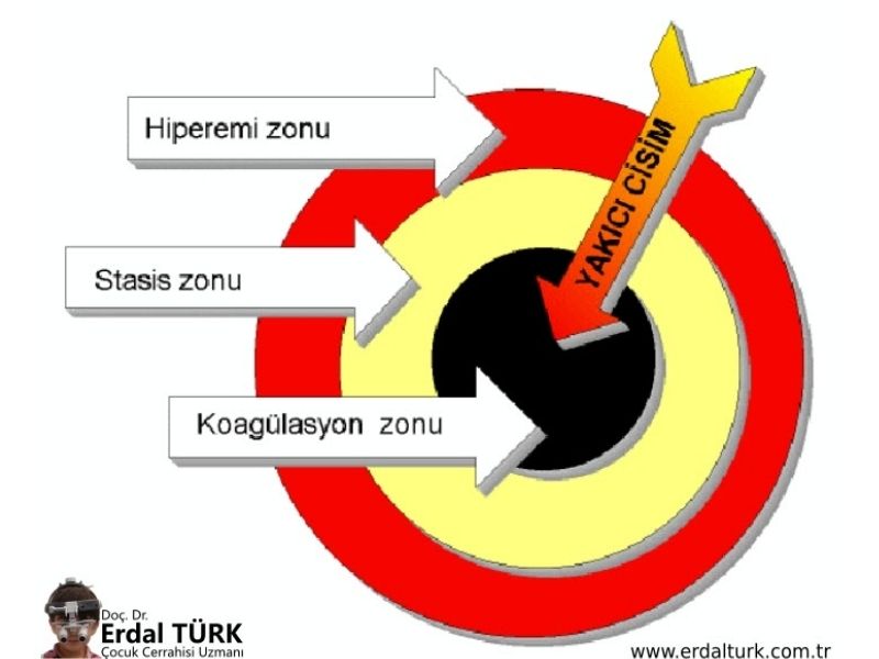 cocuklarda-yanik-ve-tedavisi-04