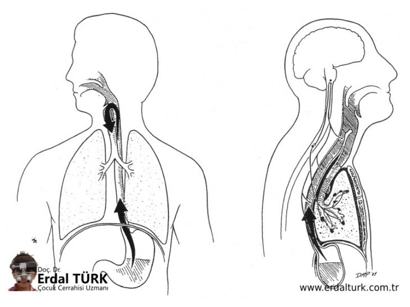 gastroozofageal-reflu-hastaligi-01