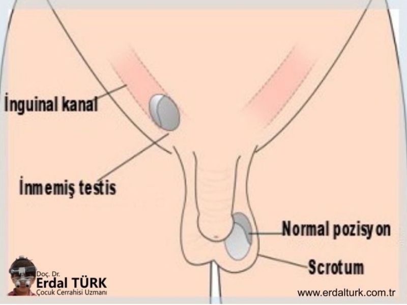 inmemis-testis-resim-01