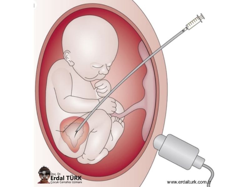 posterior-uretral-valv-resim-03