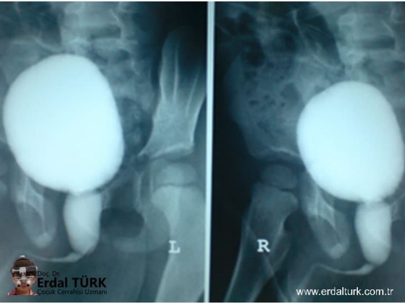 posterior-uretral-valv-resim-02