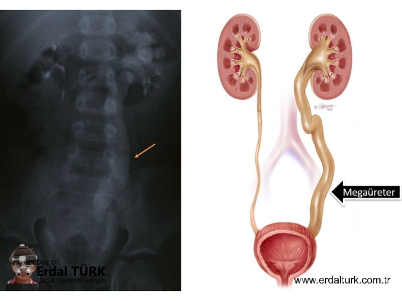 primer-megaureter-resim-01