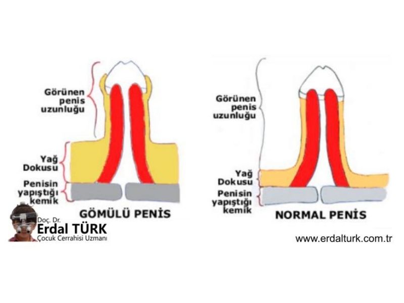 gomulu-penis-resim-01