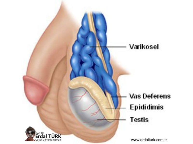 cocuklarda-varikosel-resim-1