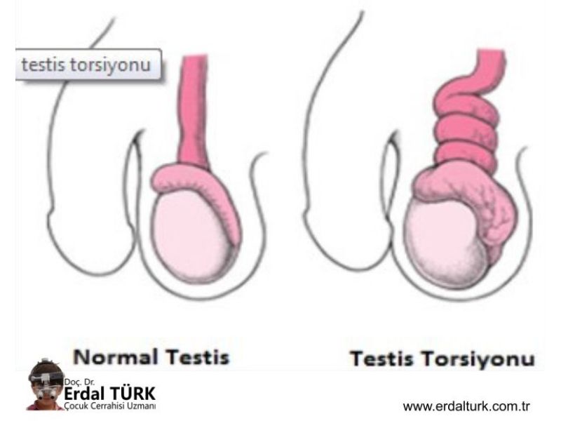 testis-torsiyonu-resim-01