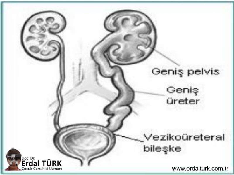 uretrovezikal-darlik-resim-01