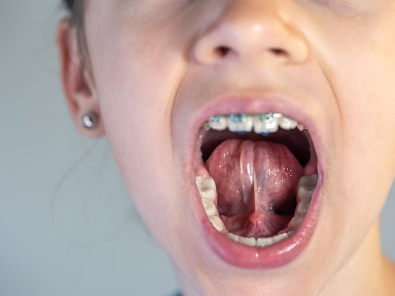 dil-bagi-isleminin-uygulanmamasi-durumunda-karsilasilabilecek-sonuclar